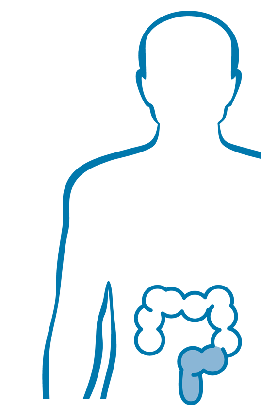 Entzündliche Darmerkrankungen